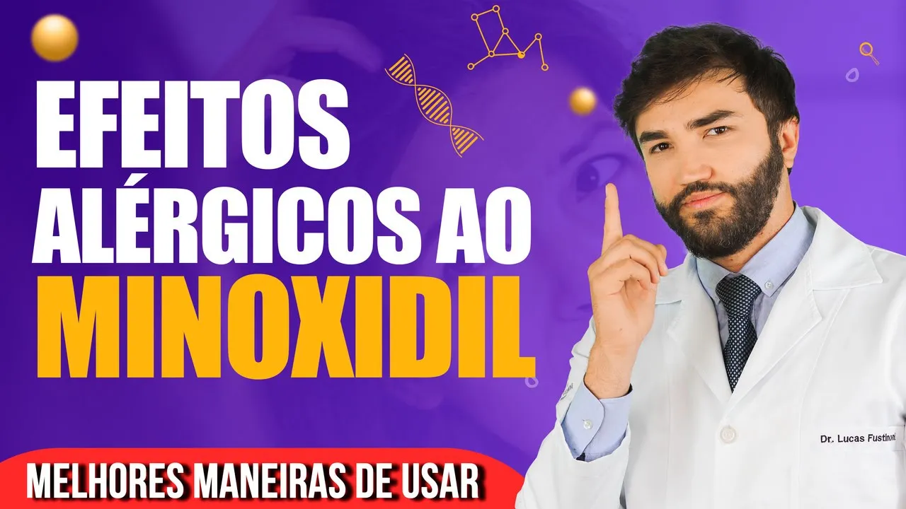 Imagem video aula doutor lucas fustinoni cabelo de mulher tudo sobre alergia e efeitos colaterais do minoxidil.webp