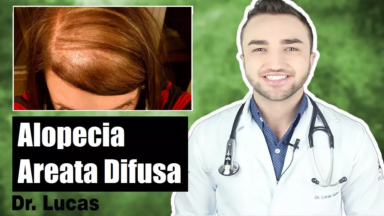 Imagem video aula doutor lucas fustinoni cuidados com cabelo alopecia areata difusa incognito queda de cabelo difusa dr.webp