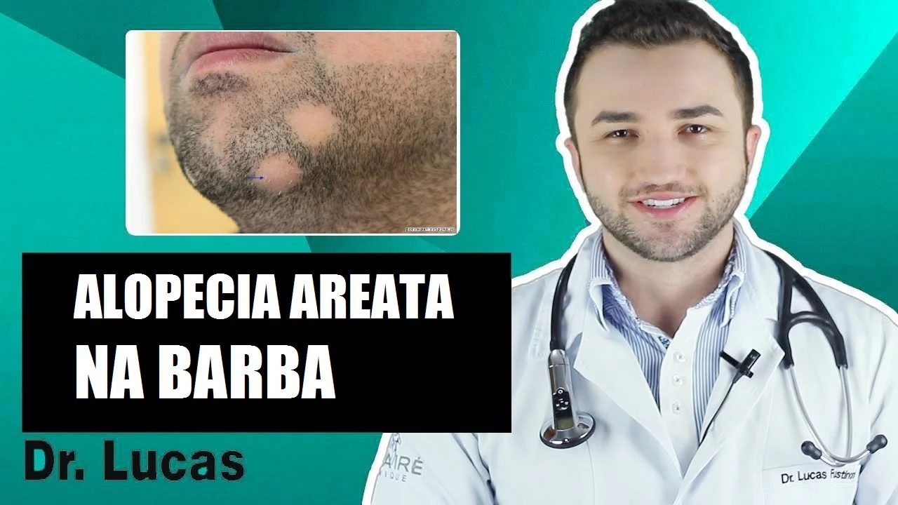 Imagem video aula doutor lucas fustinoni cuidados com cabelo alopecia areata na barba falhas grandes na barba dr.webp