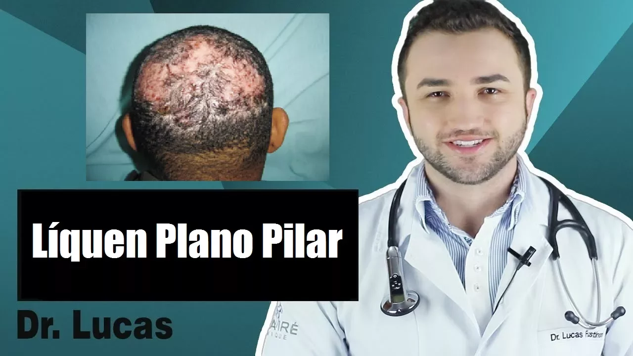 Imagem video aula doutor lucas fustinoni cuidados com cabelo tudo sobre liquen plano pilar queda de cabelo dr.webp
