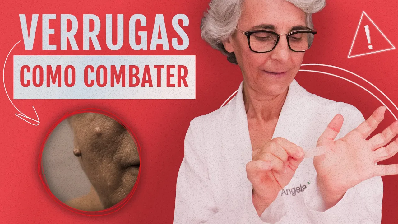 Imagem video aula doutora angela xavier saude tratamentos combata as verrugas de forma simples.webp