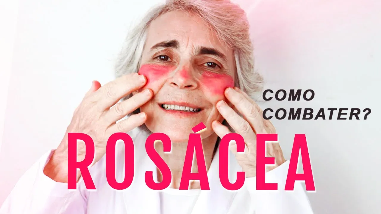 Imagem video aula doutora angela xavier saude tratamentos rosacea o que e como cuidar qual o tratamento dicas como combater e ficar livre.webp